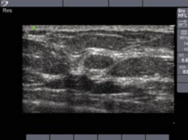 Ecógrafo Sonosite Micromaxx